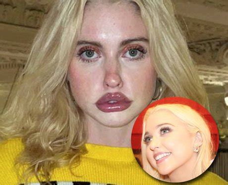 chloe cherry lips real or fake